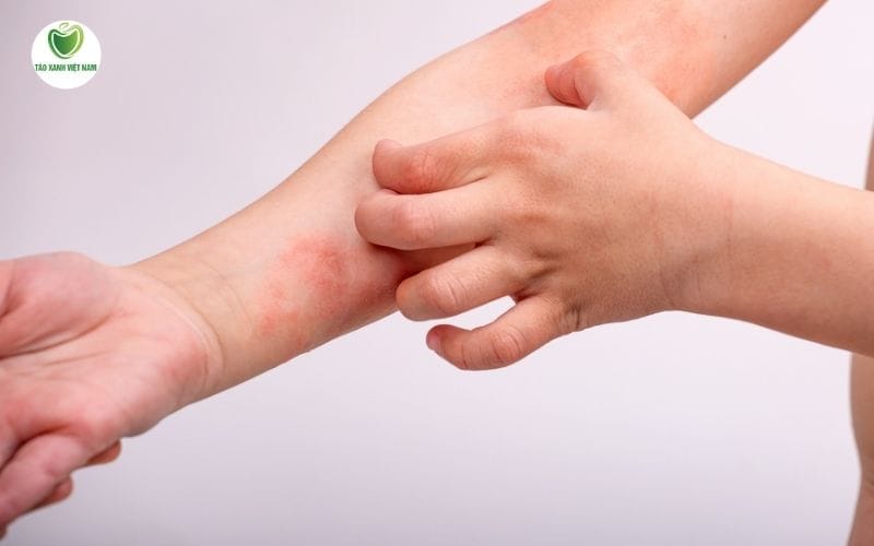 Triệu chứng nhẹ, có thể tự cải thiện tại nhà khi trẻ bị ngứa vùng kín