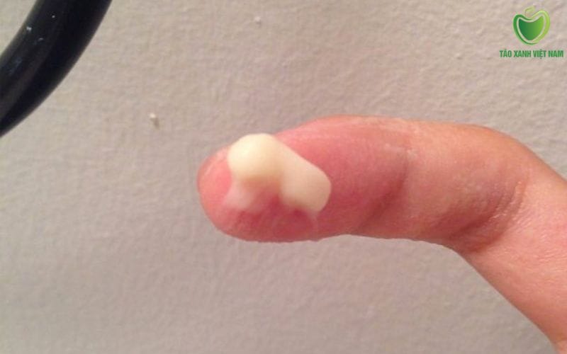 Dịch bã đậu trắng nguyên nhân chính do nấm candida