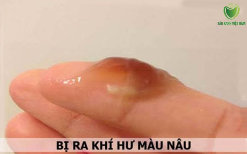 Dịch bã đậu màu nâu do máu cũ, viêm nhiễm tử cung