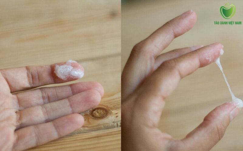 Dịch trắng có mùi hôi – Thường do viêm âm đạo do vi khuẩn (BV)