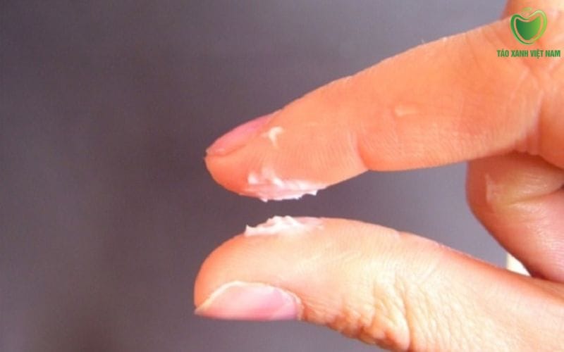 Dịch trắng và nổi hạt trắng – Có thể là nấm Candida nặng hoặc mụn rộp sinh dục