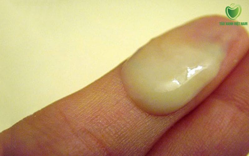 Dịch vàng hoặc xanh – Thường liên quan đến viêm nhiễm do vi khuẩn hoặc STDs