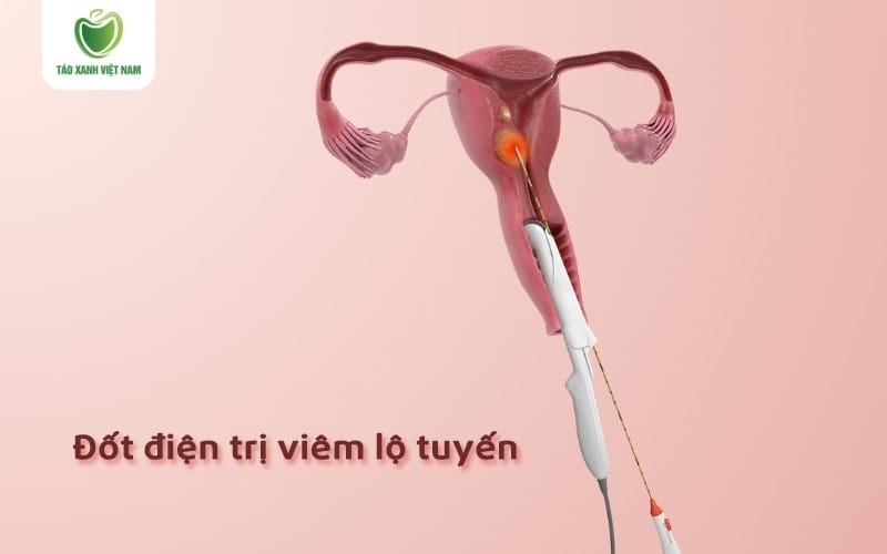 Đốt điện phục hồi chậm nhưng tỷ lệ tái phát thấp