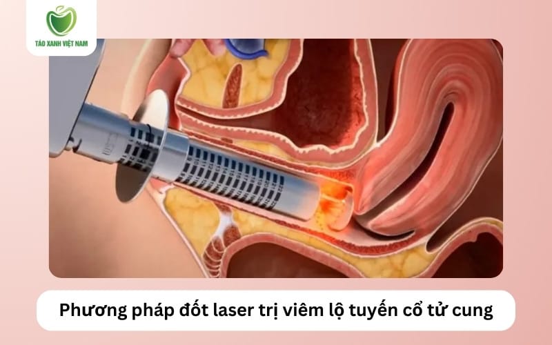 Đốt laser phục hồi nhanh hơn nhưng có khả năng tái phát