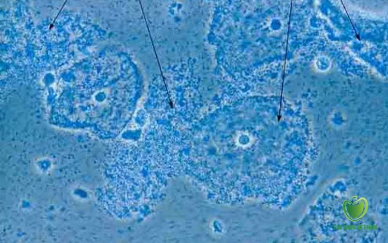 Viêm âm đạo do vi khuẩn (BV – Bacterial Vaginosis)