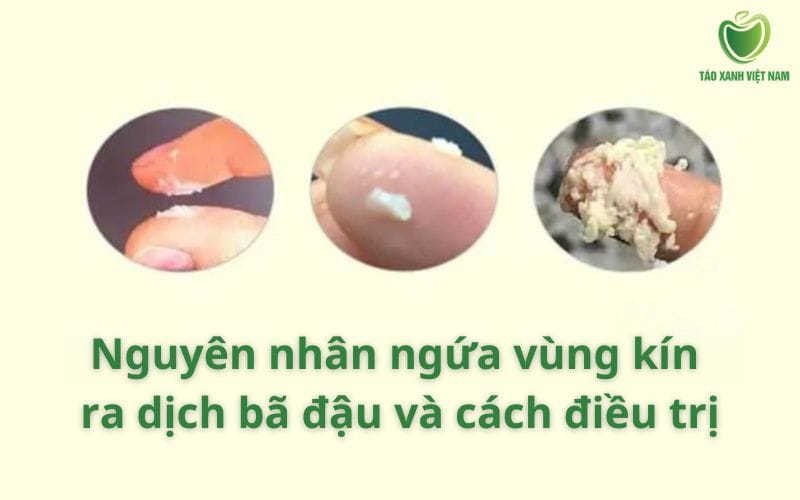 Ngứa vùng kín ra dịch bã đậu nguyên nhân và cách điều trị