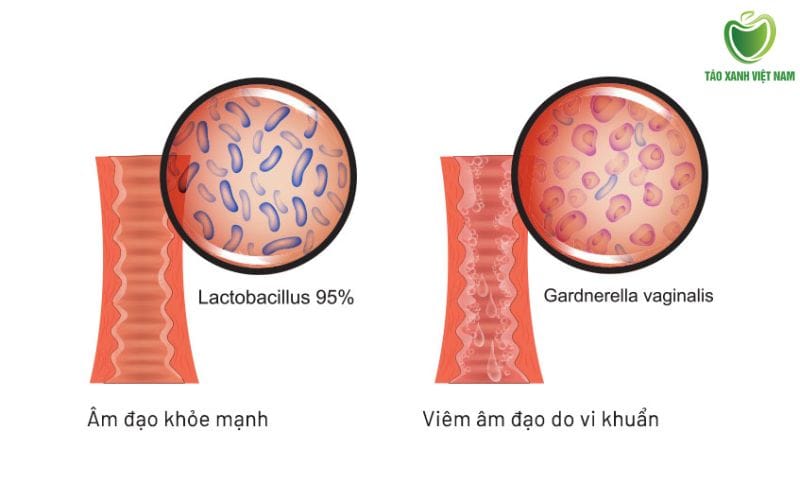 Viêm âm đạo do vi khuẩn