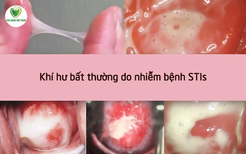 Hình ảnh khí hư khi mang thai do nhiễm bệnh STIs