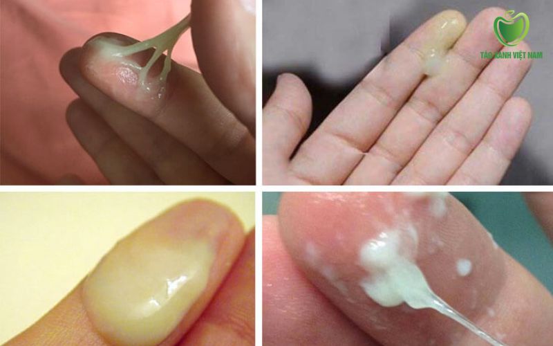Viêm âm đạo do nấm Candida gây khí hư màu trắng