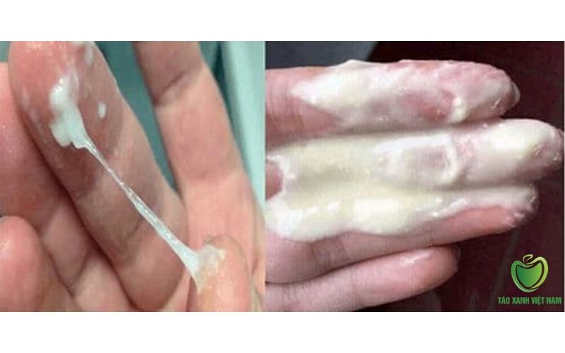Khí hư đặc như sữa chua