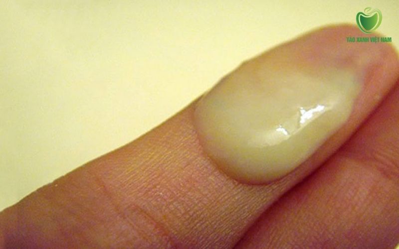 Khí hư màu vàng hoặc xanh lục