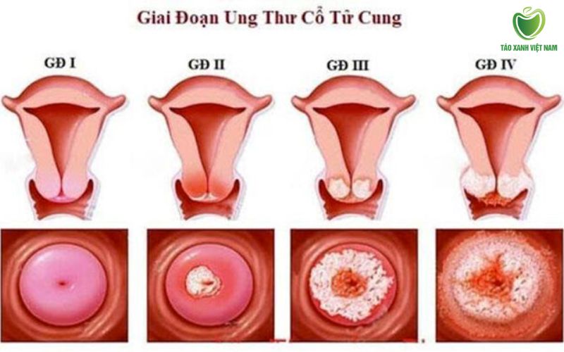 Ung thư cổ tử cung (hiếm gặp)