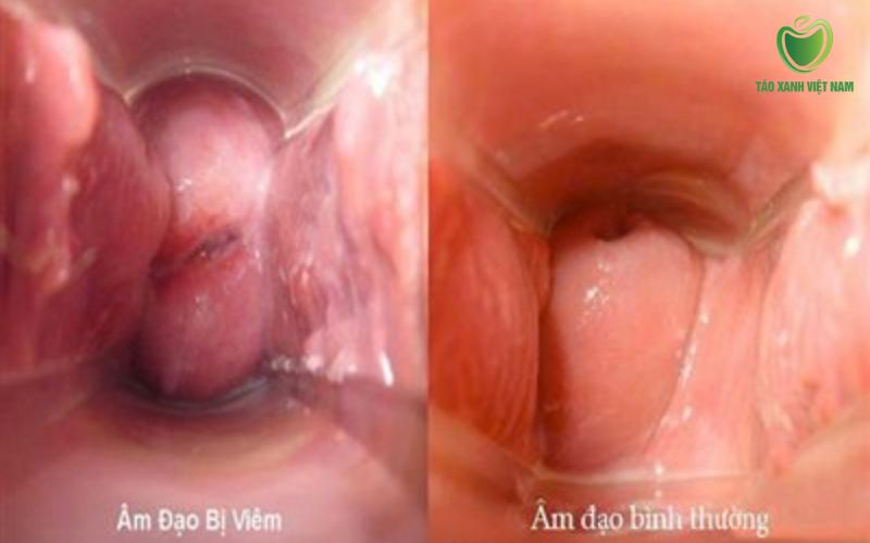 Viêm nội mạc tử cung, viêm âm đạo nặng