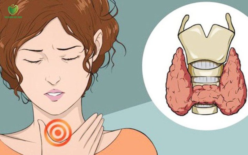 Bệnh tuyến giáp gây khí hư bất thường Bệnh tuyến giáp gây khí hư bất thường