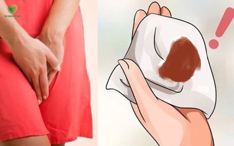 Ra khí hư màu nâu sau kỳ kinh nguyệt có nguy hiểm Ra khí hư màu nâu sau kỳ kinh nguyệt có nguy hiểm