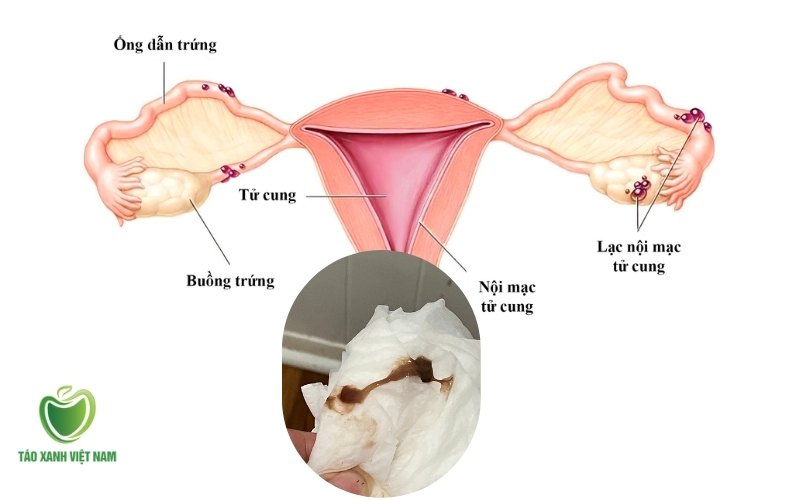 Lạc nội mạc tử cung