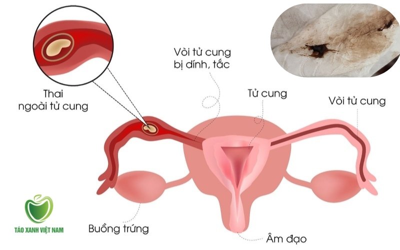 Thai ngoài tử cung
