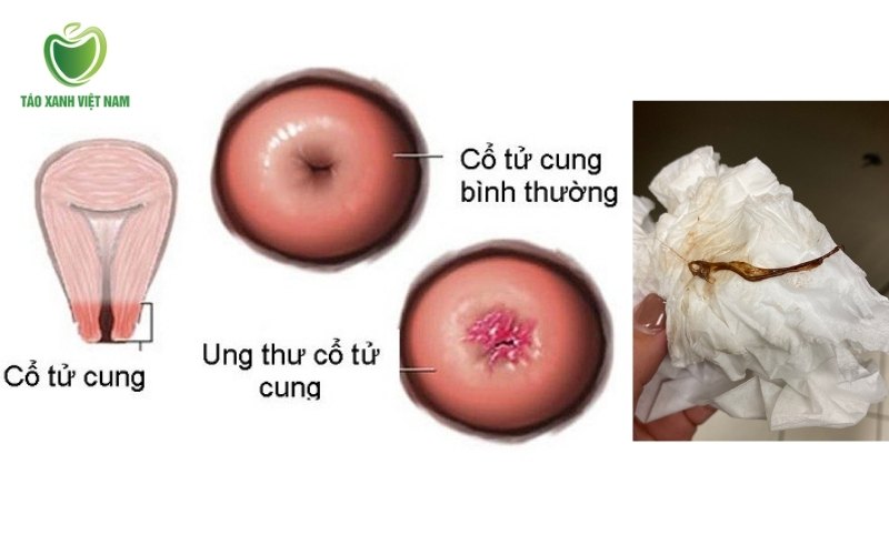 Ung thư cổ tử cung (hiếm gặp)