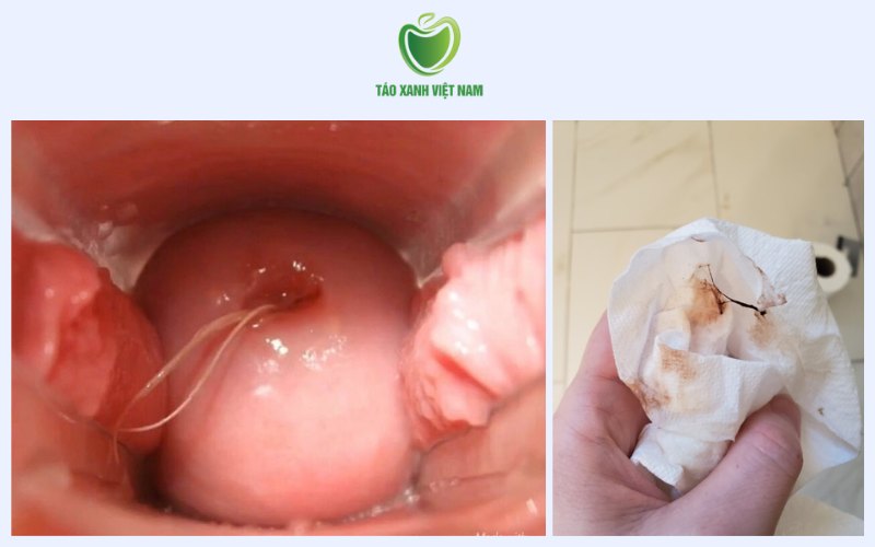 Viêm âm đạo, viêm cổ tử cung