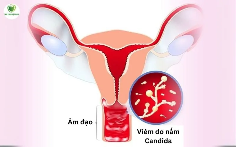 Hình ảnh viêm vùng kín do nấm Candida